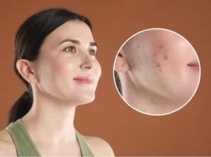 woman-with-acne-and-close-up-magnification-of-skin-2026-05-14-16-35-04-utc